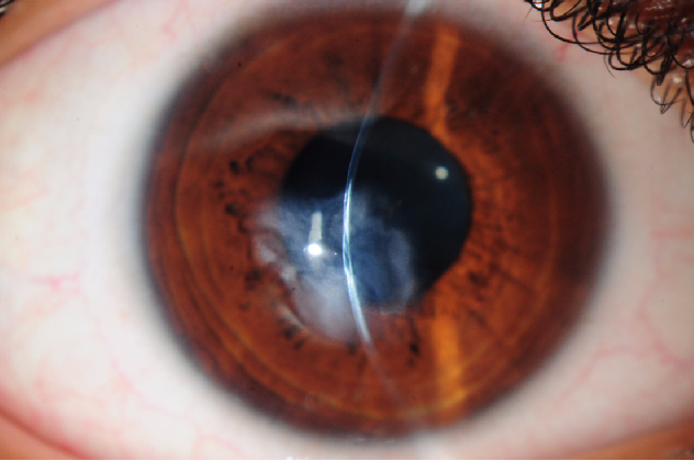 Hornhautnarbe Keratokonus Keratoplastik Kontakltinsen Salzburg