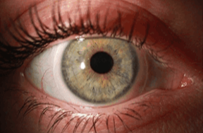 Sklerallinse Sekleralschale Hornhautverletzung" Individuallins "Sehen mit Keratokonus"