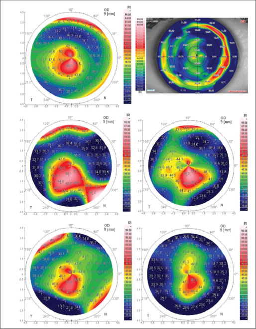 Hornhauttopographie Hornhautoberfläche Hornhautvermessung 
