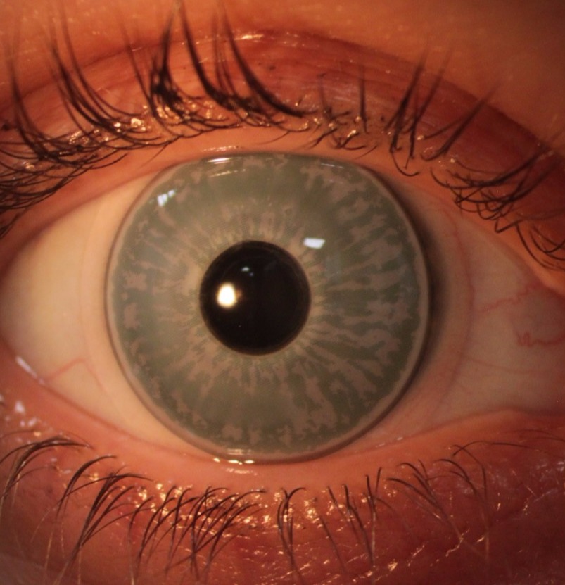 Irisprintlinse Speziallinse Iriskolobom Hornhautnarben Hornhautdefekt