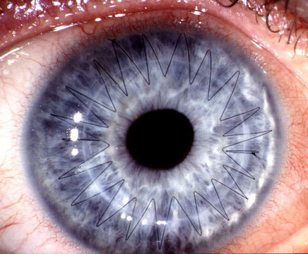 Hornhauttransplantation Keratoplastik "Naht Auge" "Fäden in der Hornhaut"
