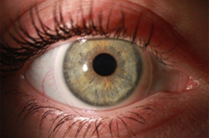 Monatslinse Tageslinse Weichlinse Mutlifokallinse